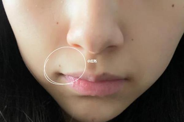 女相嘴角有痣右边有痣、女人右嘴角上方有黑痣