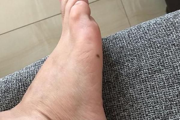 左脚底侧面痣相—左脚侧面长痣