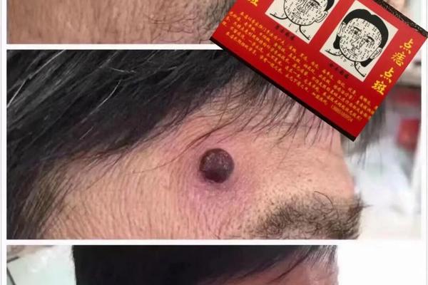 肉痣与相_长肉痣代表什么