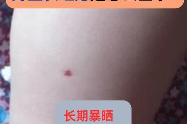 大腿内侧红痣相的寓意、女人大腿上有红痣代表什么
