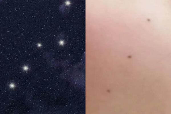 身上有北斗七星痣相的人—人身上有北斗七星是咋回事