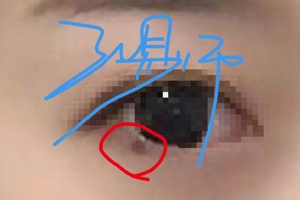眼睛下长痣是吉相吗—痣长在眼睛下面是什么意思