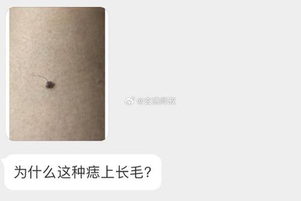 痣上长毛痣相;痣上面长毛图片