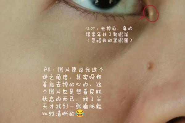 眼角周边的痣相、眼睛周边的脂肪粒怎样去除