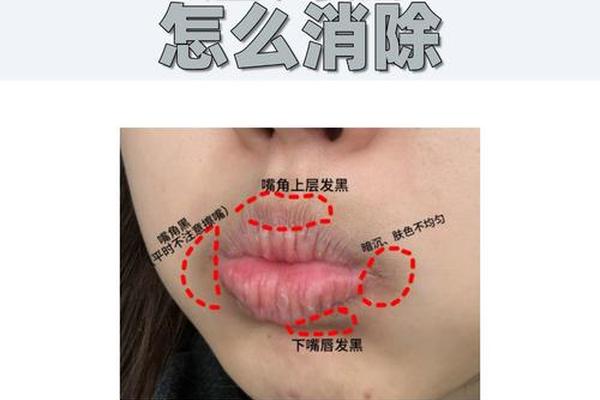 唇周痣相-唇周是哪个部位