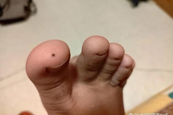 脚趾拇有痣相 脚窝长痣的痣相图解 脚趾拇有痣相 脚窝长痣的痣相图解