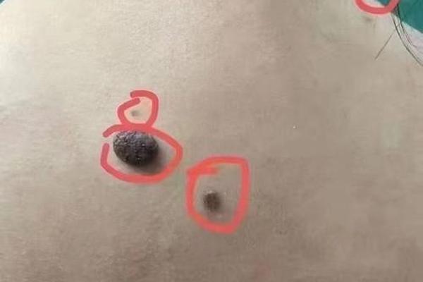 痣相防父、人背痣穷一生,人背猴苦到头