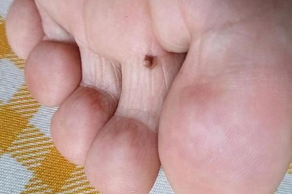 痣相脚趾_脚趾长痣图解大全
