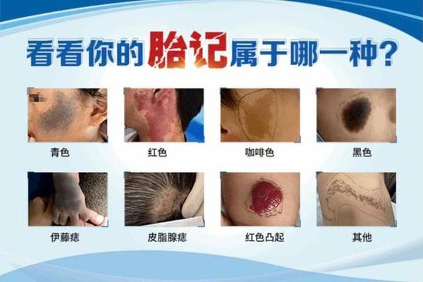 胎记图片大全图解 痣相—好看的胎记图片