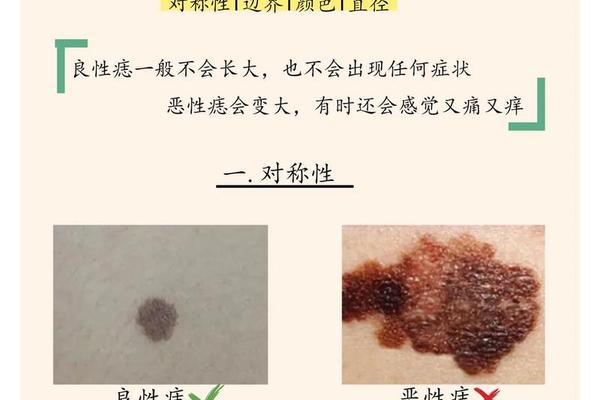 痣相滤镜软件哪个好用;测痣相app