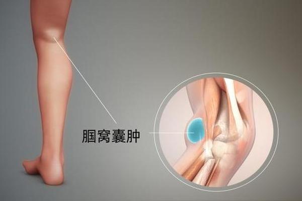 膝盖窝上的痣相;腘窝筋上摸到有疙瘩
