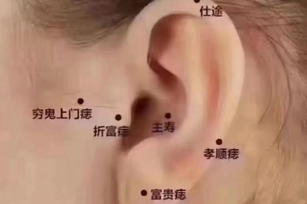 耳相痣图解 痣在耳朵图片大全