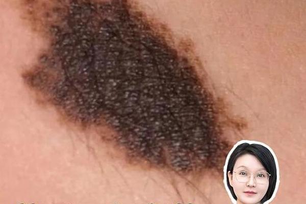 痣相毛发—痣上有毛发是良性的吗