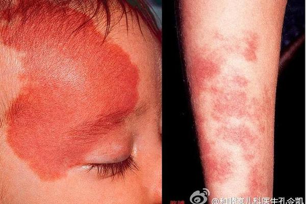 痣相两眉间红色胎记;眉间出现红色印记是怎么回事