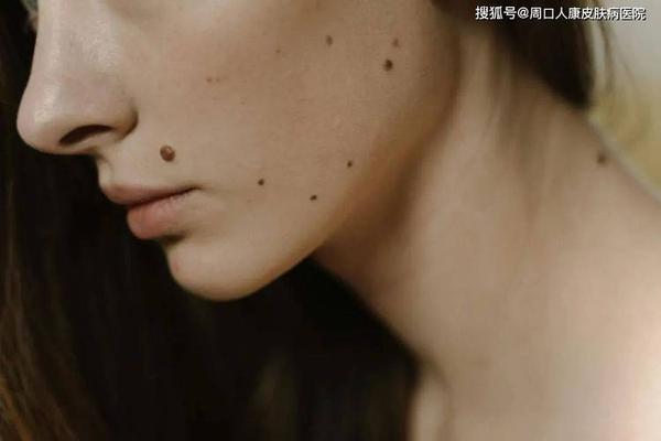 韩国相师点痣视频播放-祛痣视频全过程
