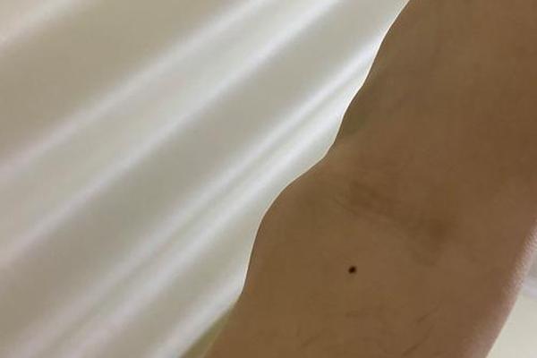 脚踝内侧痣相_脚踝有痣代表什么图解 脚踝内侧痣相_脚踝有痣代表什么图解