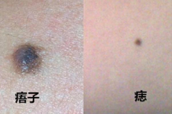 牛马 痣相_牛痣是什么东西