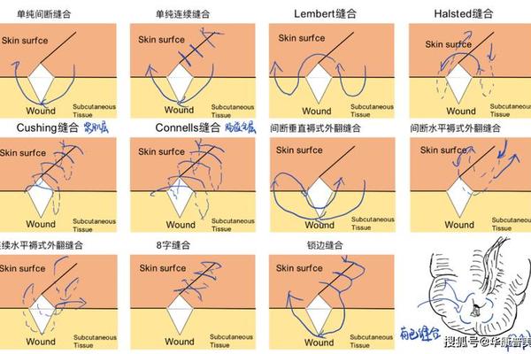 八字缝合