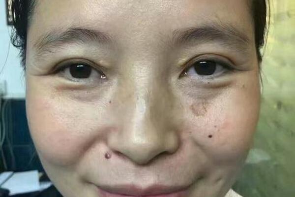 相家庄市场祛痣堂(痣斑堂祛斑效果怎么样)