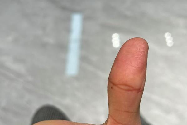 大拇指痣相解 大拇指上长个痣是什么意思