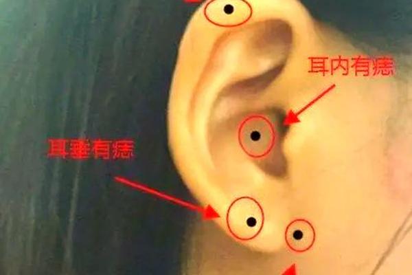 耳下痣相、耳朵下边的痣