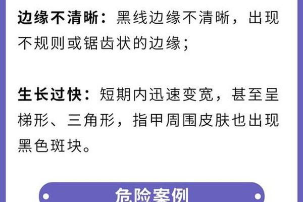 指甲里长痣 痣相—指甲长痣代表什么意思