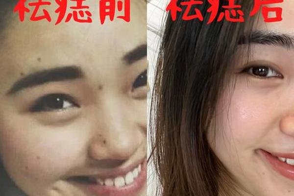 祛痣影相运气_祛痣能改变命运吗