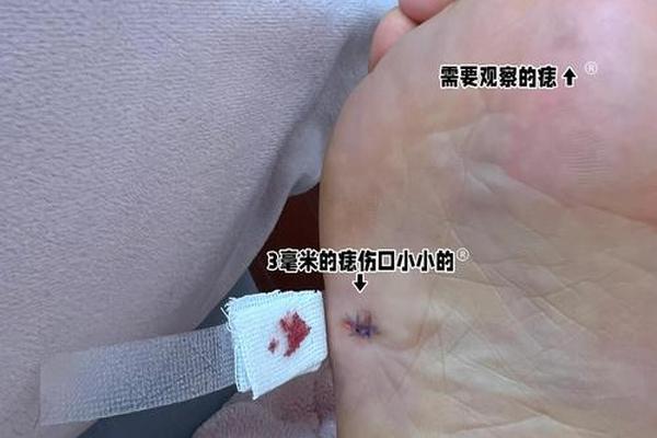 痣相脚底有二颗痣;脚底二颗痣代表什么