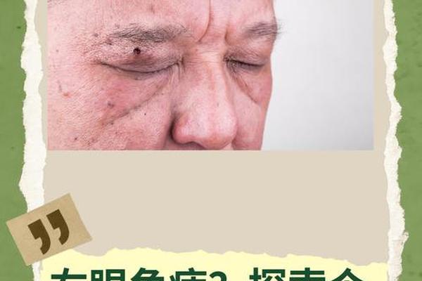 男人右眼头有痣的相—男人右眼头有痣好不好