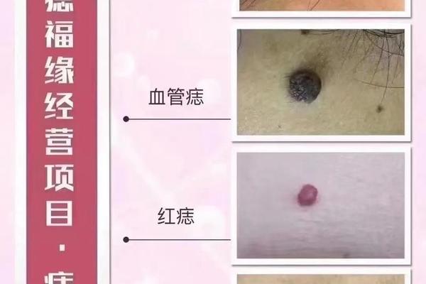 痣相哪些能去掉_哪些痣需要去除图片 痣相哪些能去掉_哪些痣需要去除图片
