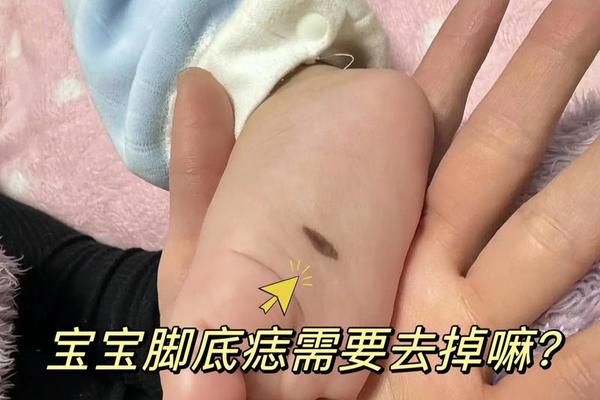 小孩脚长痣相 小孩脚底有痣代表什么