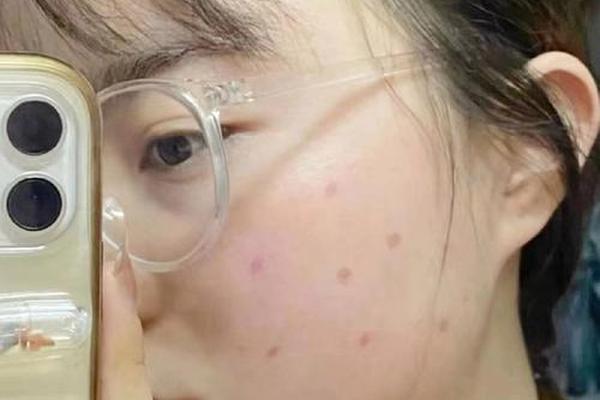 苏州市相城医院可以点痣吗-苏州哪个医院可以点痣