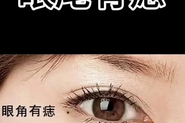 男人眼尾痣相最准图—男人右眼尾痣相图解