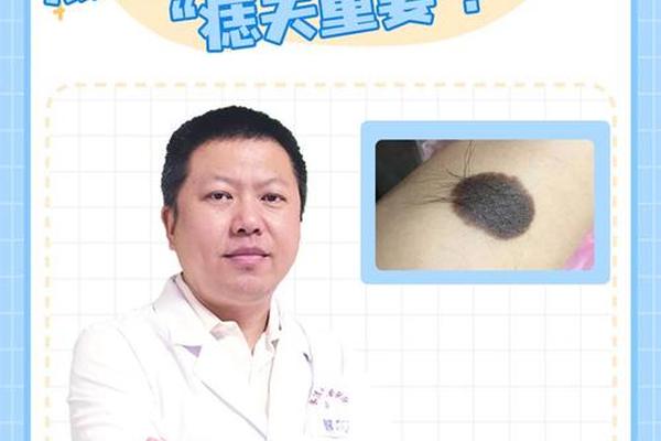 痣相毛相 痣上长毛好不好面相