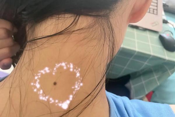 后脖子痣相—脖子后面有痣图解