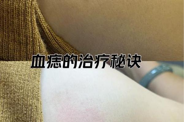 痣相发际线红痣;发际线上方一点长了一颗红痣 痣相发际线红痣;发际线上方一点长了一颗红痣