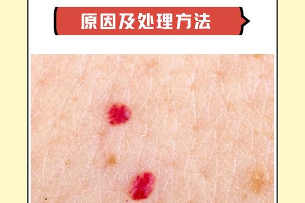痣相颜色黑里透红 红痣颜色变深了是怎么回事 痣相颜色黑里透红 红痣颜色变深了是怎么回事
