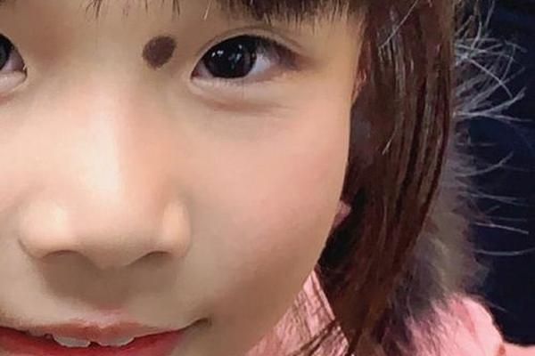 娃娃痣相,儿童痣图片大全