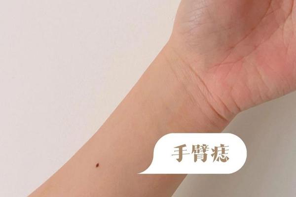 怎么看手腕痣相_痣相大全详解