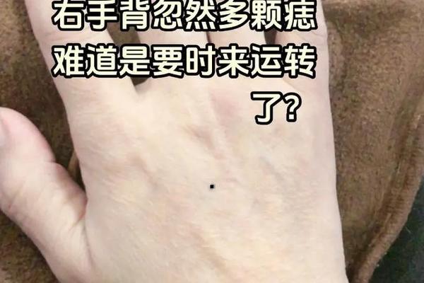 手背恶痣影响相吗、手背长痣的手相
