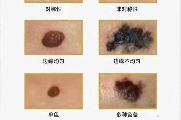 正常痣的样子图片 痣相,100种痣的图片