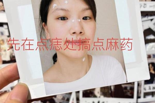 激光祛痣挂哪相科_手术祛痣挂什么科