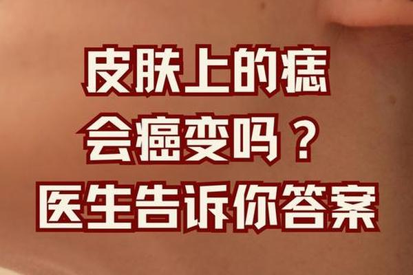 与皮肤相平的痣叫什么痣(平痣和凸痣哪个福气)