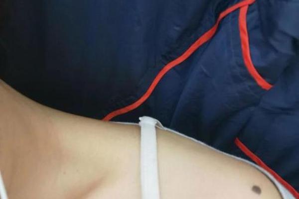 女士肩膀痣图相解大全—肩膀痣图解