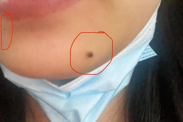 痣相下巴以黄毛,下巴痣上长毛好不好
