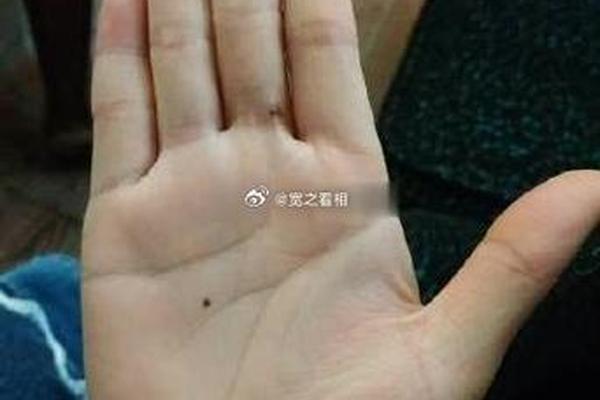 中指长痣相,左手中指突然长了颗痣