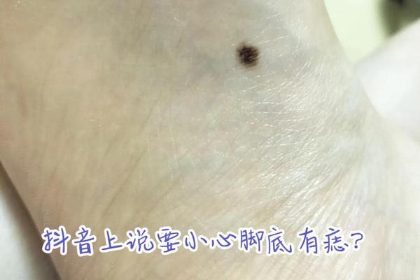 麻衣神相足底有痣的小孩,儿子脚底有一个痣好吗