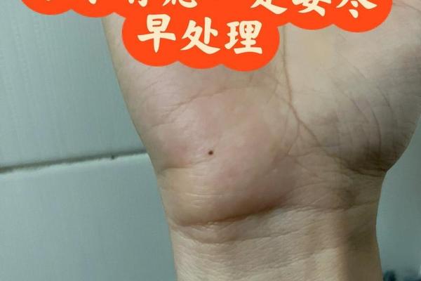 手掌有痣什么相(手掌突然长了一个痣)