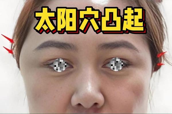 太阳穴有痣相;太阳痣是什么样子的