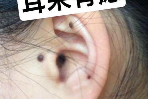 左耳朵痣女相 左边耳朵长痣代表什么